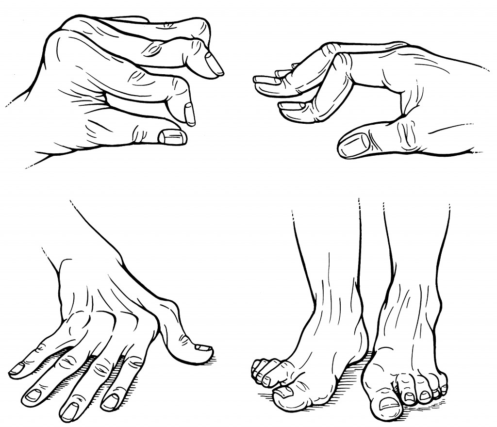 Figure. Rheumatoid arthritis hand deformities